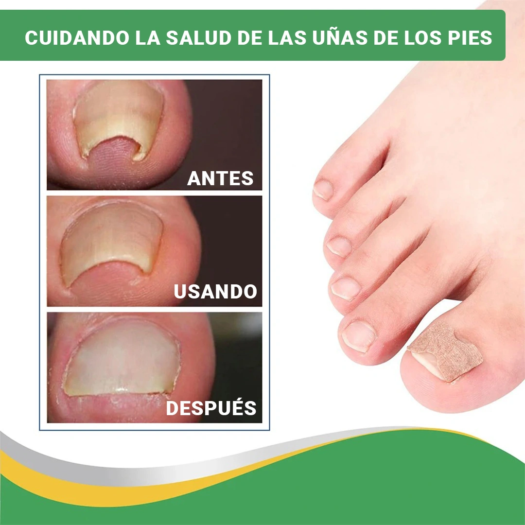 🎁OFERTA PIDE 10 LLEVA 20🎁 PARCHES PARA HONGOS Y UÑAS ENCARNADAS