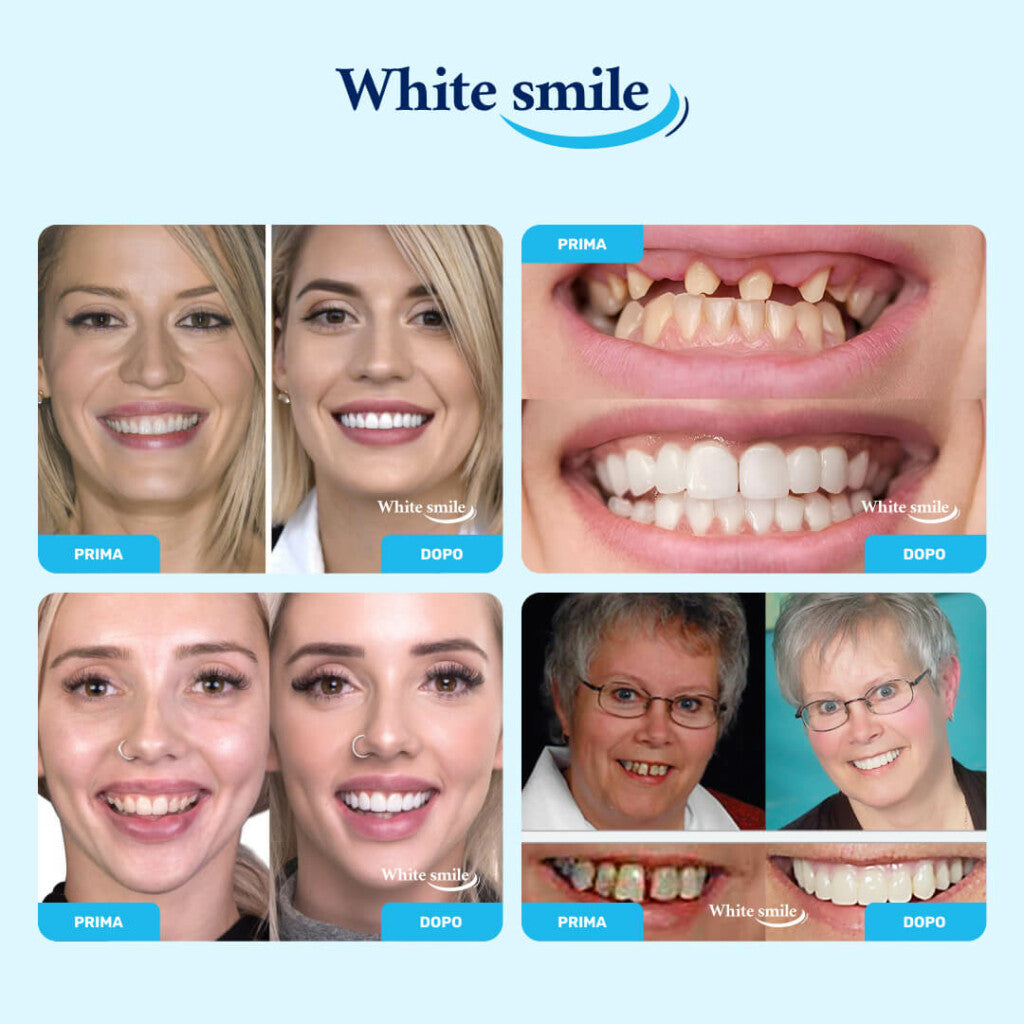 🎁 OFERTA ESPECIAL 50% 🎁 Sonrisa blanca™ – Dientes postizos para una sonrisa perfecta